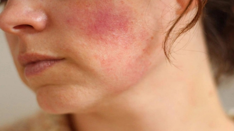 Những tác dụng phụ thường gặp khi dùng Retinol