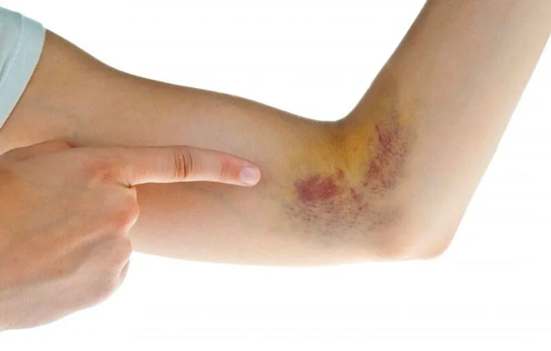 Người hay bị bầm tím là thiếu chất gì? Xử lý ra sao?