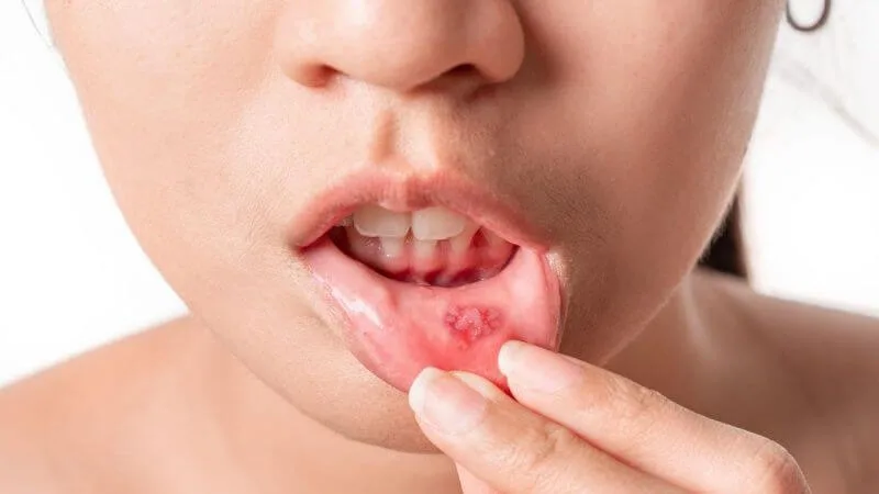 Trẻ hay bị nhiệt miệng là thiếu chất gì? Bổ sung chất ra sao?