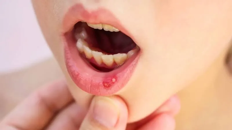 Trẻ hay bị nhiệt miệng là thiếu chất gì? Bổ sung chất ra sao?
