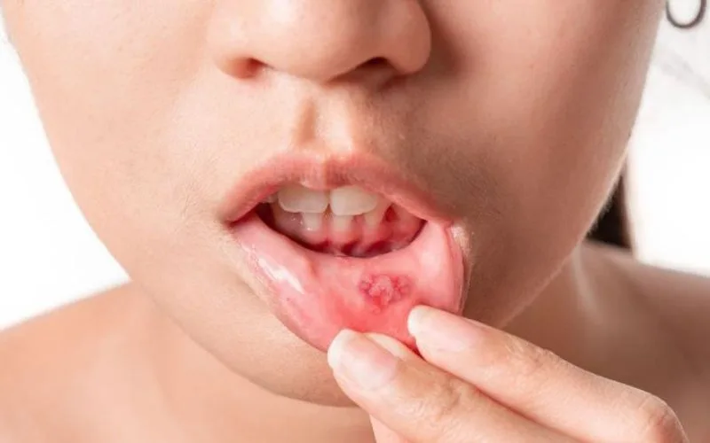 Bị nhiệt miệng thường xuyên có nguy hiểm không? cách trị tại nhà đơn giản