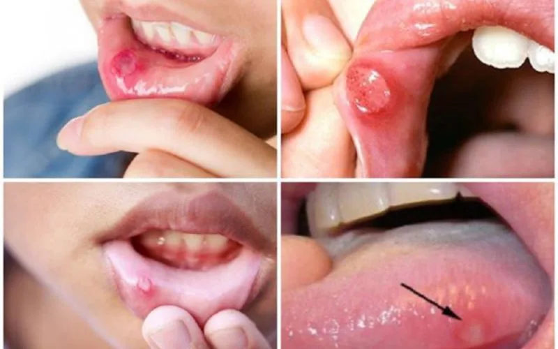 Bị nhiệt miệng thường xuyên có nguy hiểm không? cách trị tại nhà đơn giản