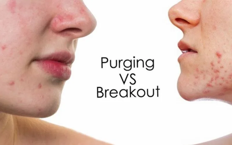 Da bị break out là gì? có dấu hiệu gì? nên làm gì khi bị?