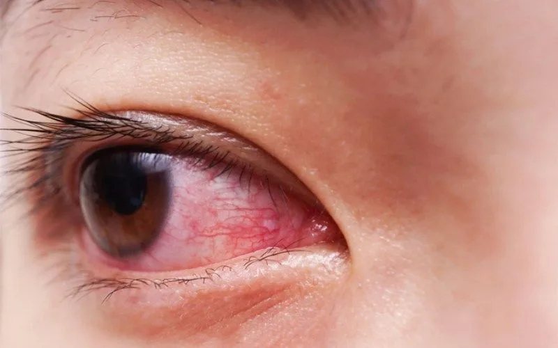 Đau mắt đỏ có ăn được rau muống không? cách chăm sóc cho mau khỏi?