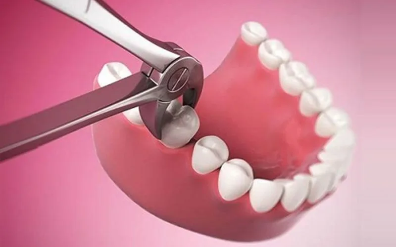 Sau khi nhổ răng số 8 cần kiêng gì? ăn gì thì tốt? bao lâu thì lành?