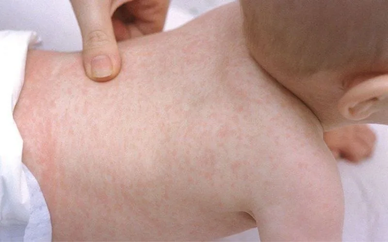 Trẻ bị phát ban sau sốt cần kiêng gì? có được nằm quạt không?