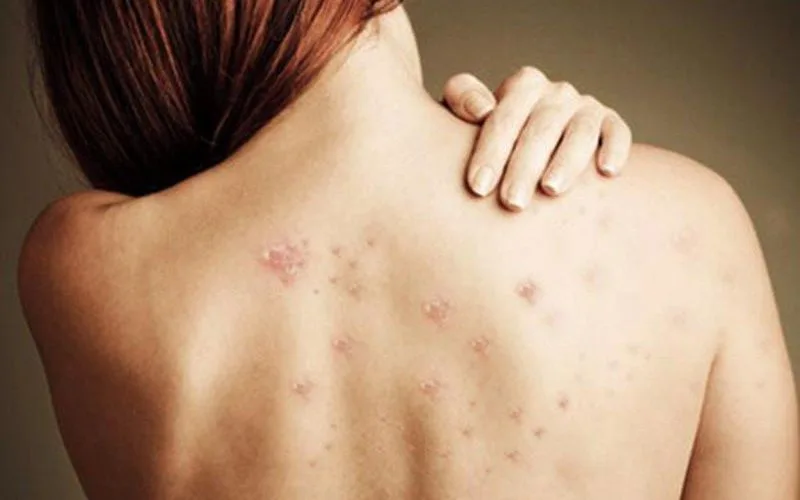 Nổi mụn ở lưng là dấu hiệu bệnh gì? cách trị dứt điểm ngay tại nhà